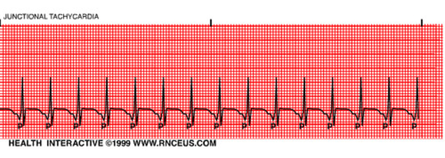 <p>Regular</p><p>Rate: >100</p><p>P Wave: NONE or INVERTED</p><p>PR Interval: None or <0.12</p><p>QRS: <0.12 sec</p>
