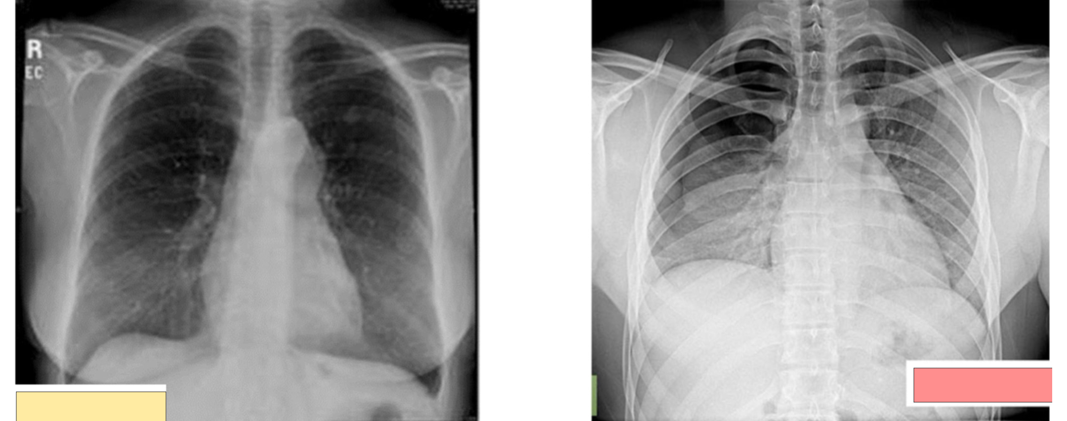 <p>What form of breathing is this on the x-ray?</p>