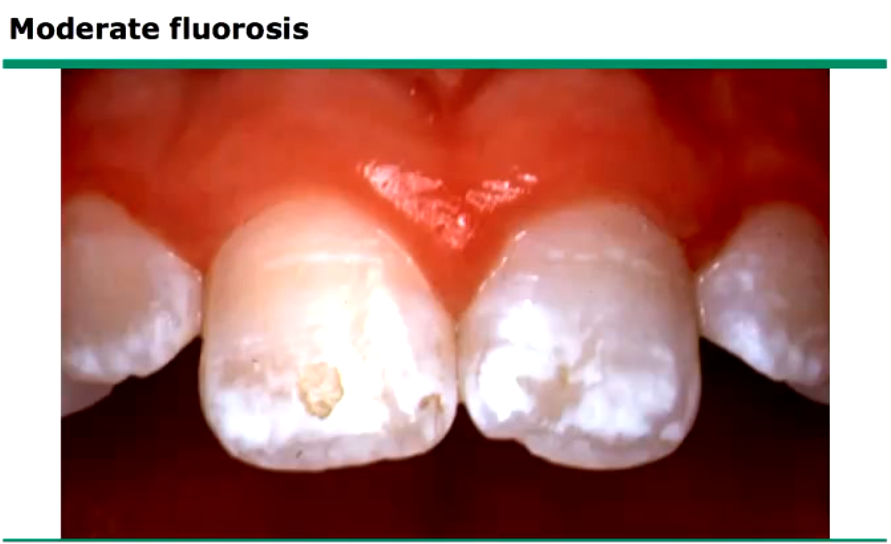 <p>fluorosis </p>