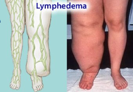 **Lymphedema**