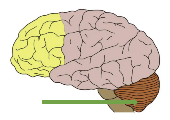 <p>A patient was diagnosed with a stroke that affected the area marked in the image. Which of the following impairments are MOST LIKELY to be seen in this patient?</p><ol><li><p>Resting tremors</p></li><li><p>Dystonia</p></li><li><p>Visual field disturbances</p></li><li><p>Dysmetria</p></li></ol><p></p>