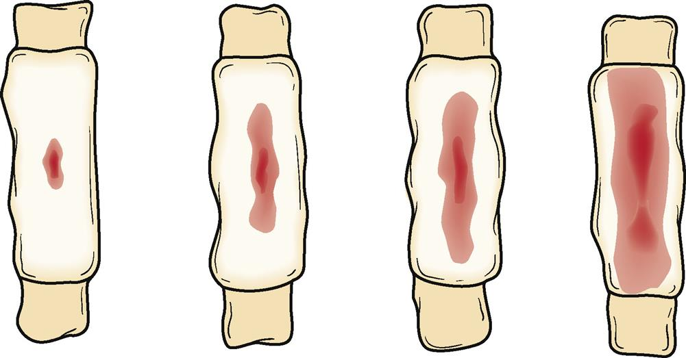 <p>ch. 21 - nurses must accurately estimate blood loss by visually assessing __________, described as scant, light, moderate, or heavy</p>