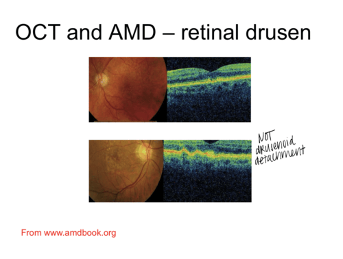<p>Drusen on an OCT (Pic)</p>