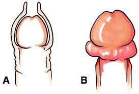 <p><strong>Paraphimosis</strong></p><p>-Prepuce (foreskin) becomes _________ behind the corona and forms a tight ____ that cannot be pulled _____ over the glans </p><p>-Urologic __________</p>