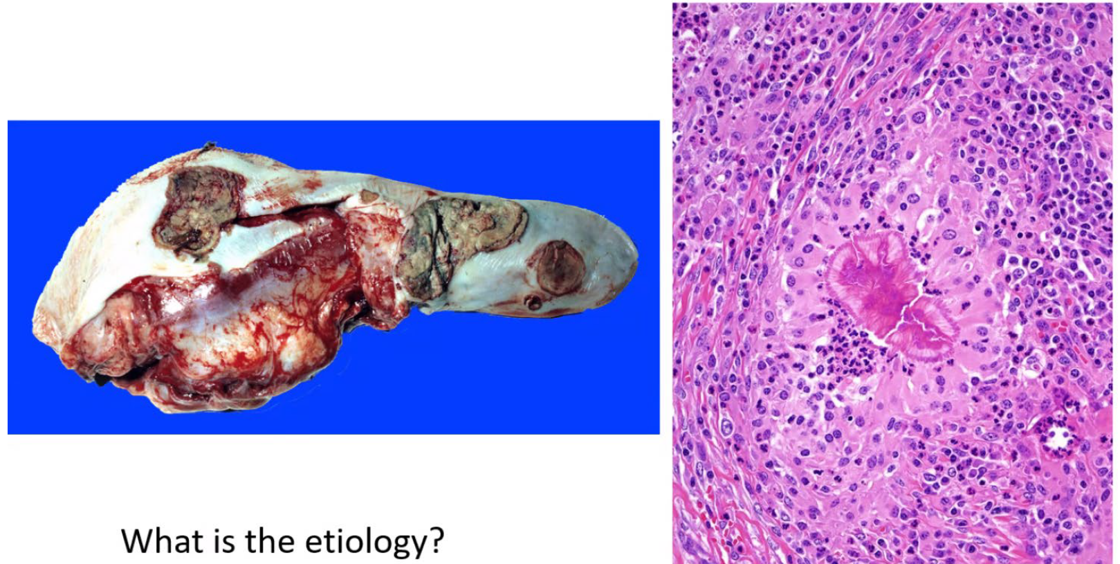 <p>What is the etiology?</p><p>A-Actinobacillus /igneresi</p><p>B-Actinomyces bovis</p><p>C-Mycobacterium bovis</p><p>D-Streptococcus suis</p>