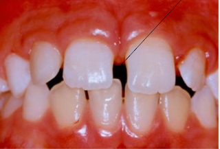 <p>Any spacing between teeth in the same arch. </p>