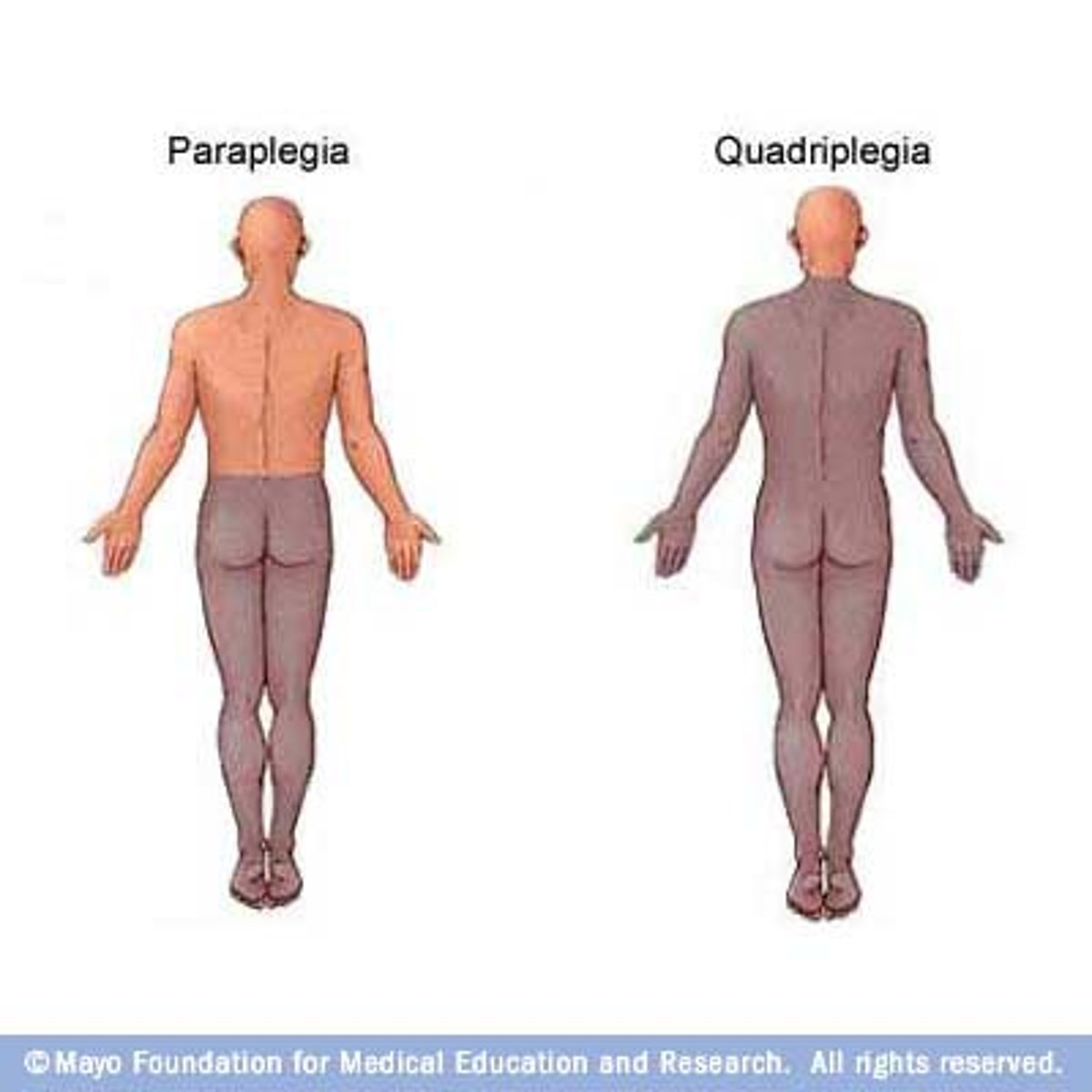 <p>paralysis from the waist down</p>