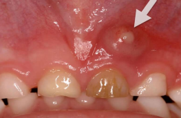 <p><strong>Risk Factors and Pathophysiology of Dental Abscess </strong></p><p>-Same risk factors as cavities, making them the most common cause </p><p>-_________ enters tooth via cavity/crack and travels down the root → bacteria continues to multiply leading to accumulation of ___</p><p>-____________ is the most common bacterial cause </p><p>-If the abscess invades the dental ____, there will be complications in the surrounding neurovascular structures and tissues </p>