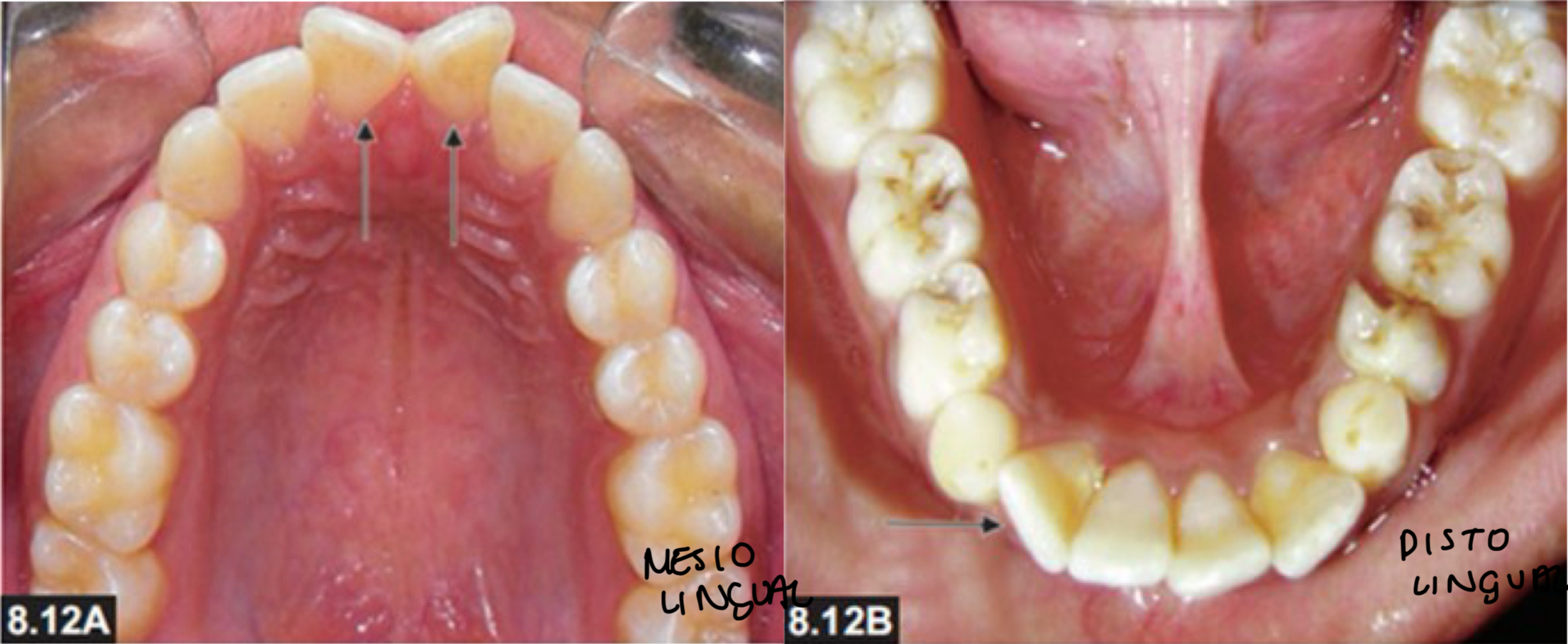 <p>Movement of tooth around its long axis- described in 2 ways depending on which surface</p><p>Mesiolingual (distolabial)</p><p>Distolingual (mesiolabial)</p>
