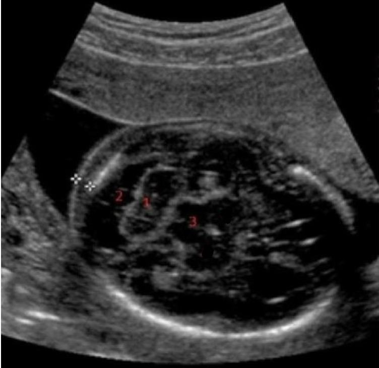 <p>what is #1</p><p>a) nuchal skin fold</p><p>b) cerebellum</p><p>c) caudate nucleus</p><p>d) cisterna magna</p>