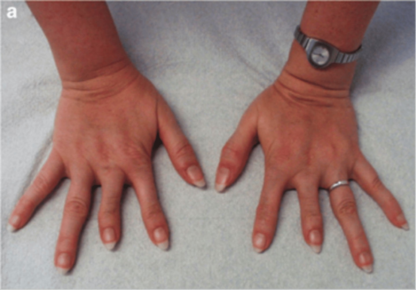 <p>short fingers</p>