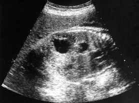 <p><span><span>A sagittal image of the fetal abdomen most likely demonstrates:</span></span></p>