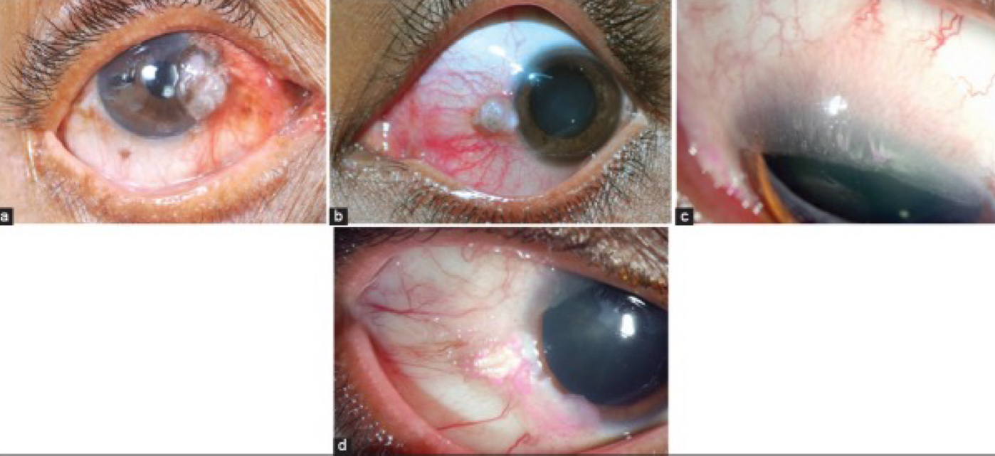 <p>Ocular Surface Squamous Neoplasia: stem cells divide inappropriately → range from mild dysplasia to invasive squamous cell carcinoma</p>