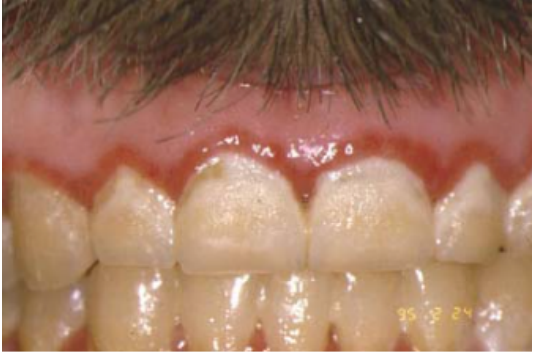 <p>Name the candidiasis associated lesion</p>