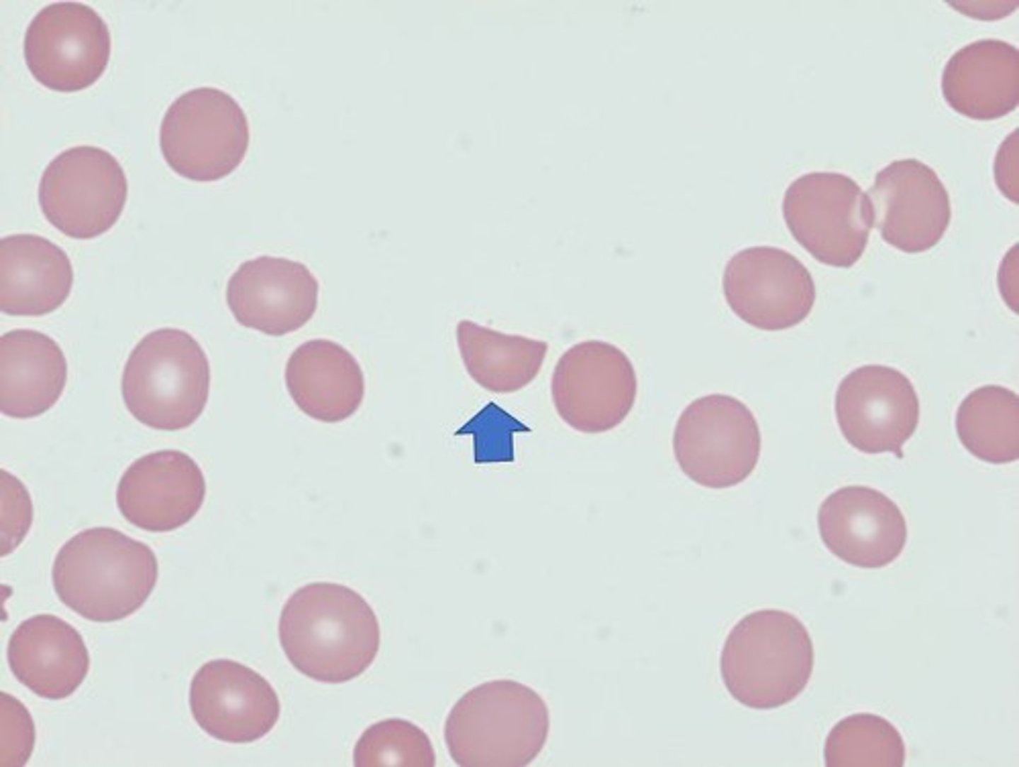 <p>Also called drepanocytes; RBC that are crescent or sickle shaped with pointed projections.</p>