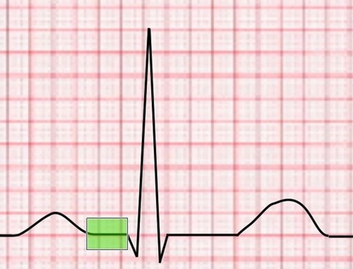 <p>P wave respresents atrial depolarization.</p><p>The "a" wave on CVP represents atrial contraction</p>