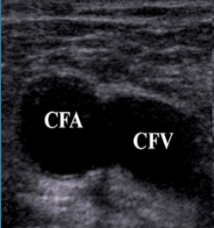 <p>What is Site 1 for a DVT?</p>