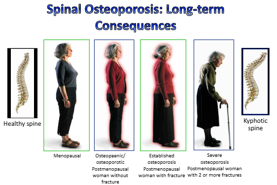 <ul><li><p>loss of bone mass/density = both mineral and osteoid decreased. normal bone but less of it, increased fracture risk&nbsp;</p></li><li><p>osteoporosis of aging- males + females have gradual decline in bone density from early adult peak</p></li><li><p>postmenopausal osteoporosis = rapid decline in female bone density following decline in estrogen at menopause</p></li><li><p>estrogen deficiency increases bone remodelling rate + degree of bone resorption</p></li><li><p>treatment = hormone replacement, biphosphonates&nbsp;</p></li></ul><p></p>