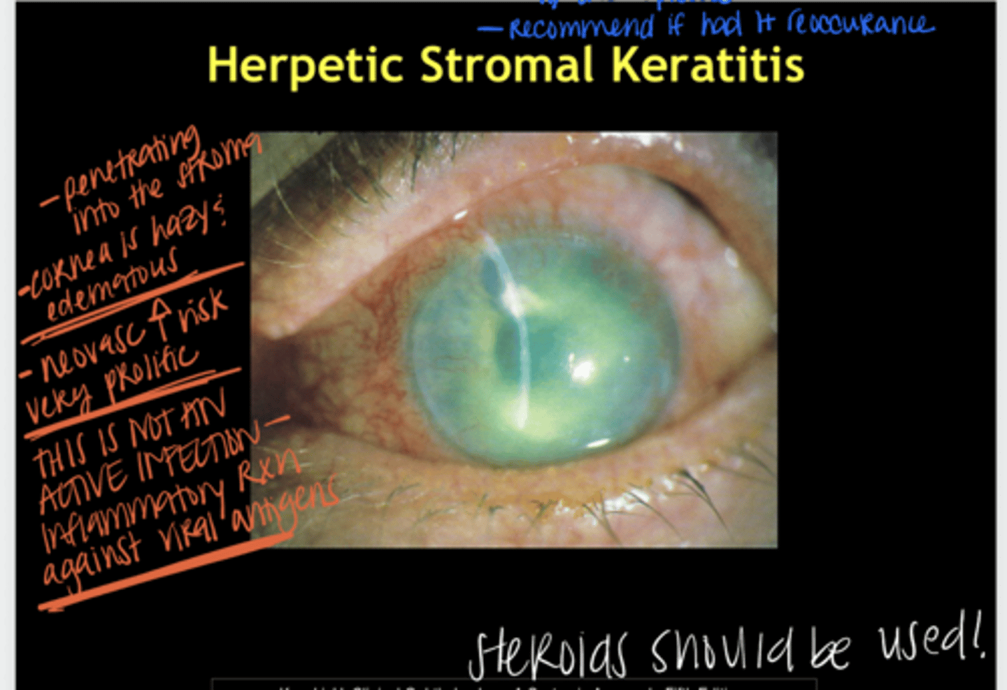<p>Herpetic Stromal Keratitis (Pic)</p>