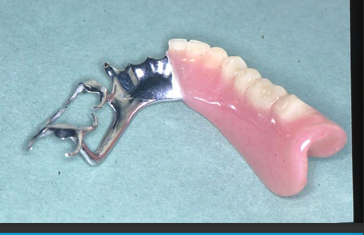 <ul><li><p>Because of the dual nature of the support - teeth and alveolar ridge </p></li><li><p>Mandibular dentures greater problem</p></li><li><p>Periodontal membrane and mucosa have different displaceabilities causing denture to <strong>tip </strong></p></li><li><p>Potential damage to <strong>abutments</strong> and to <strong>alveolar ridge </strong></p></li><li><p>patients experience denture movements during function - when biting </p></li></ul><p></p>