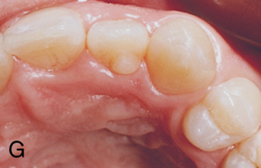 <ul><li><p>translates to tooth inside a tooth</p></li><li><p>during cap stage enamel organ may abnormally invaginate by growth into the dental papilla</p></li><li><p>(enamel folds into crown)</p></li><li><p>commonly found in permanent maxillary incisors (lateral)</p></li></ul><p></p>
