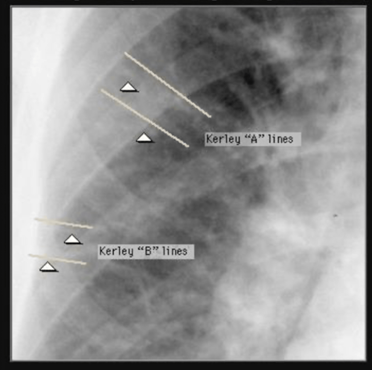 <p>kerley a and B lines</p>