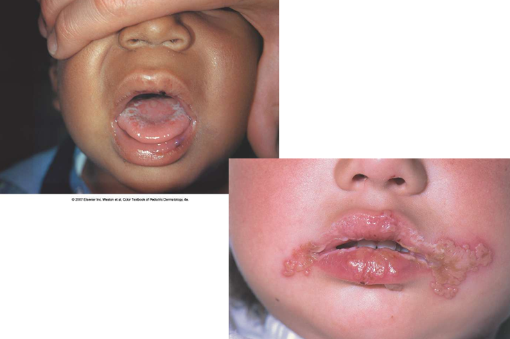 <p>Welke virale infectie zien we hier?</p>
