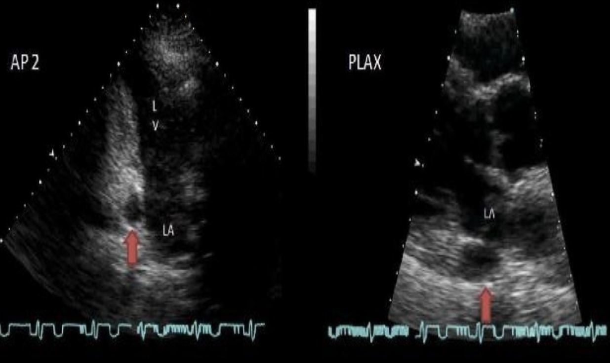 <p>Dilated coronary sinus associated with? </p>
