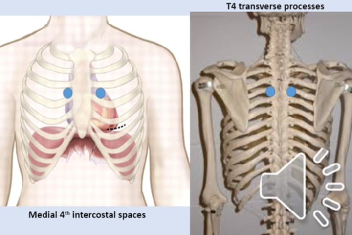 <p>anterior point: medial 4th intercostal spaces<br>posterior point: T4 transverse processes</p>