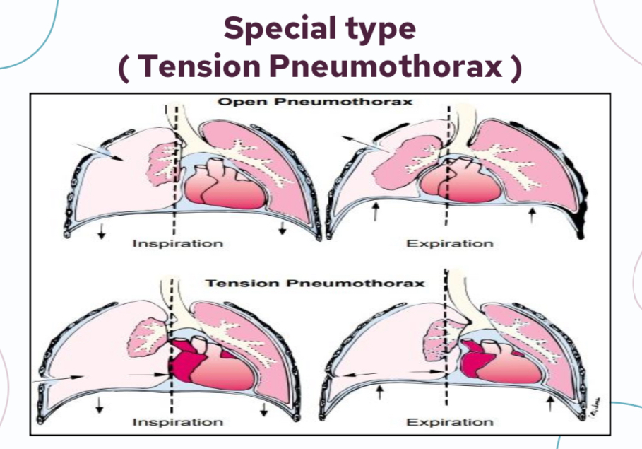 <p>In tension pneumothorax, the injured tissue acts as a one way valve so air enters during inspiration but can’t exit during expiration so air is trapped inside the pleural space and inter pleural pressure accumulates </p><p>It can be developed by spontaneous or traumatic pneumothorax </p>