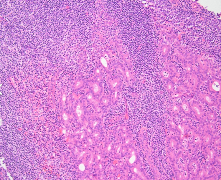 <p>Patiente de50 ans masse de la parotide </p><p>1) Diagnostic </p><p>2) localisation, sexe </p><p>3) Histologie</p><p>4) IHC</p><p>5) Molécualire </p>
