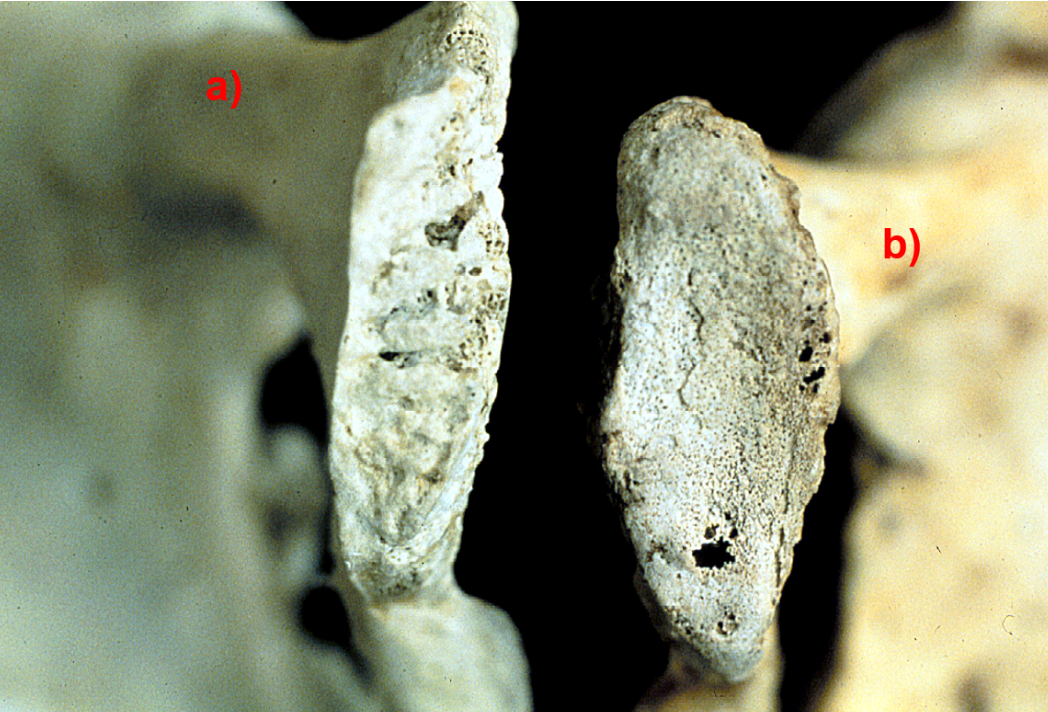 <p><span>Look at these two pubic symphyses, which one is from a younger individual? Answer A or B, the letter must be capitalized in order to receive credit for your answer</span></p>