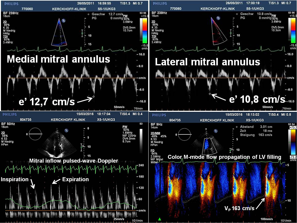<p>Explain 2 findings in these images that support the diagnosis of constrictive pericarditis.&nbsp;</p>