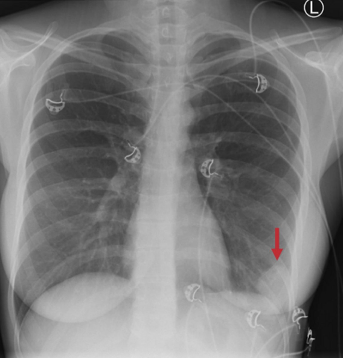<p>Name the condition, patient has recent diagnosis of pulmonary embolism</p>
