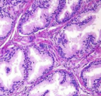 ### Hyperplasia - *Prostatic Gland*