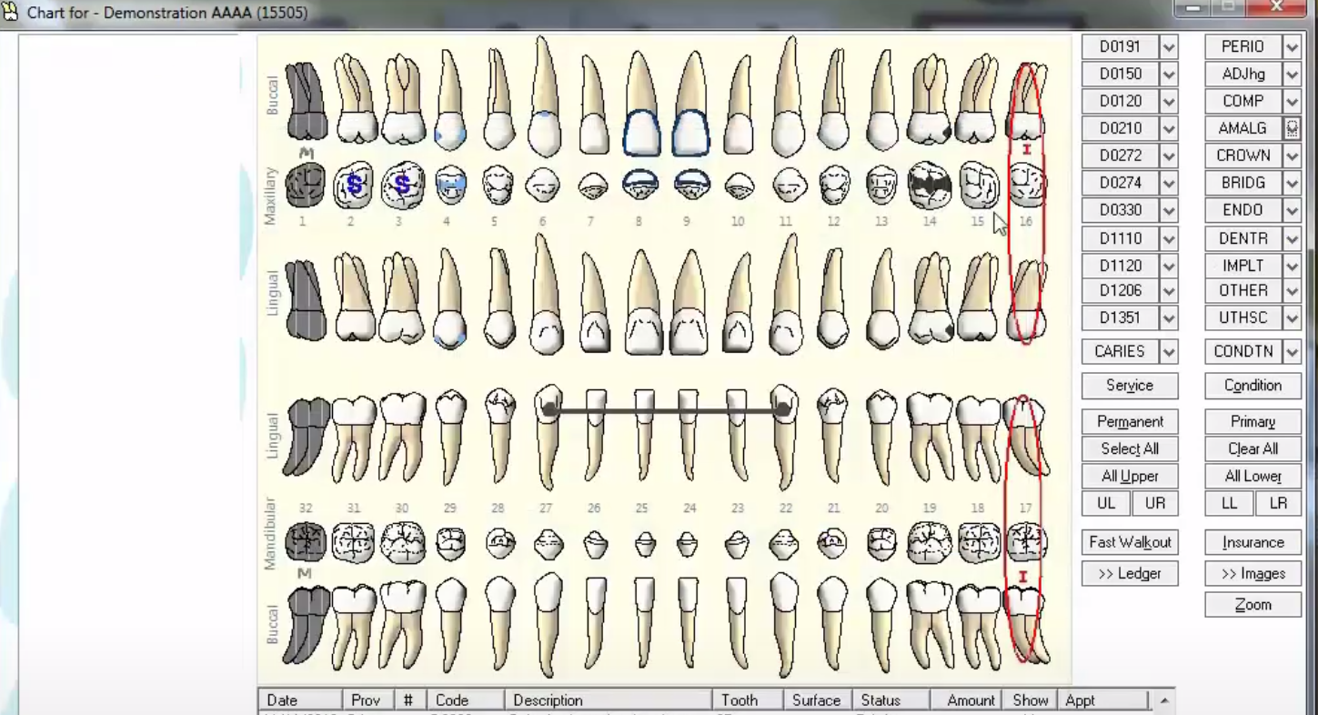 <p><span>On the chart pictured below, what type of restorative material is on tooth #14?&nbsp;</span></p>