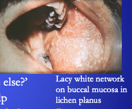 <p><span>Lacy white network on buccal mucosa in <strong>[...]</strong></span></p>