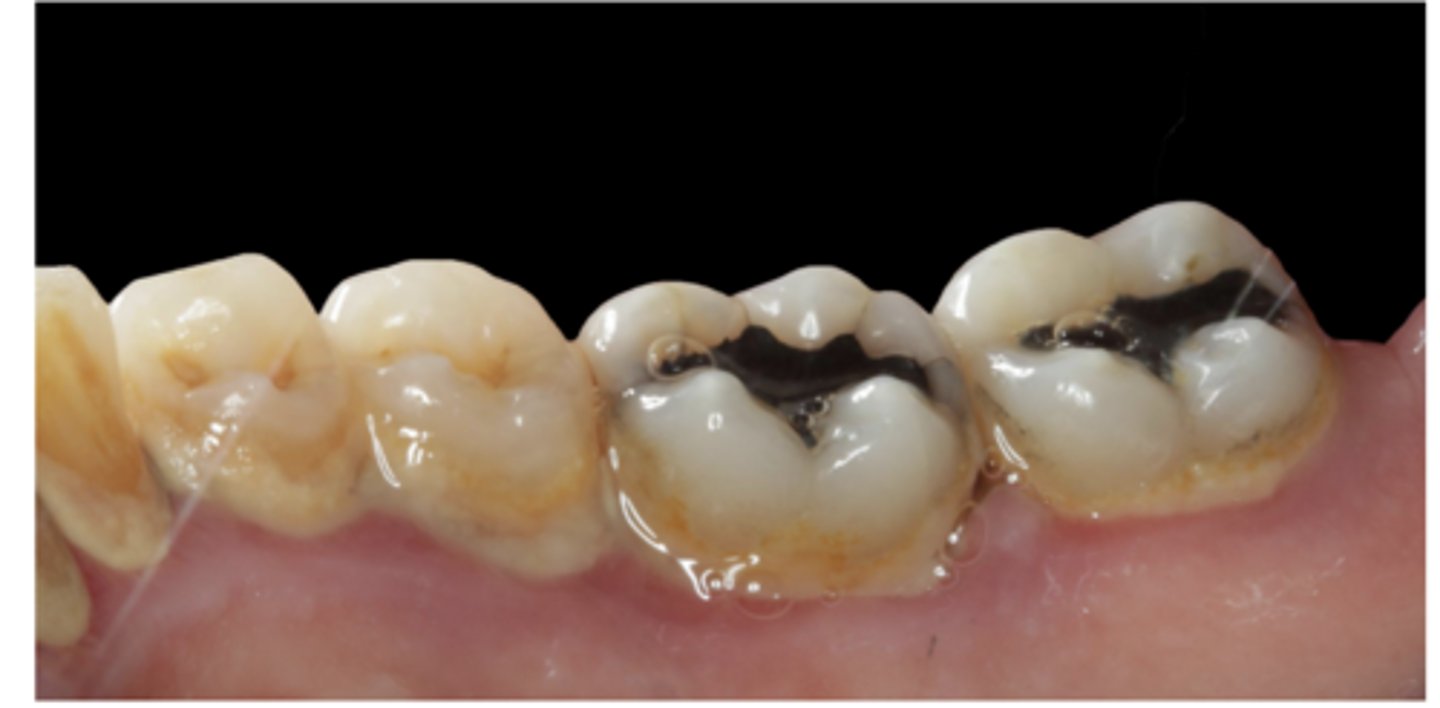 <p>drying, biofilm, calculus</p>
