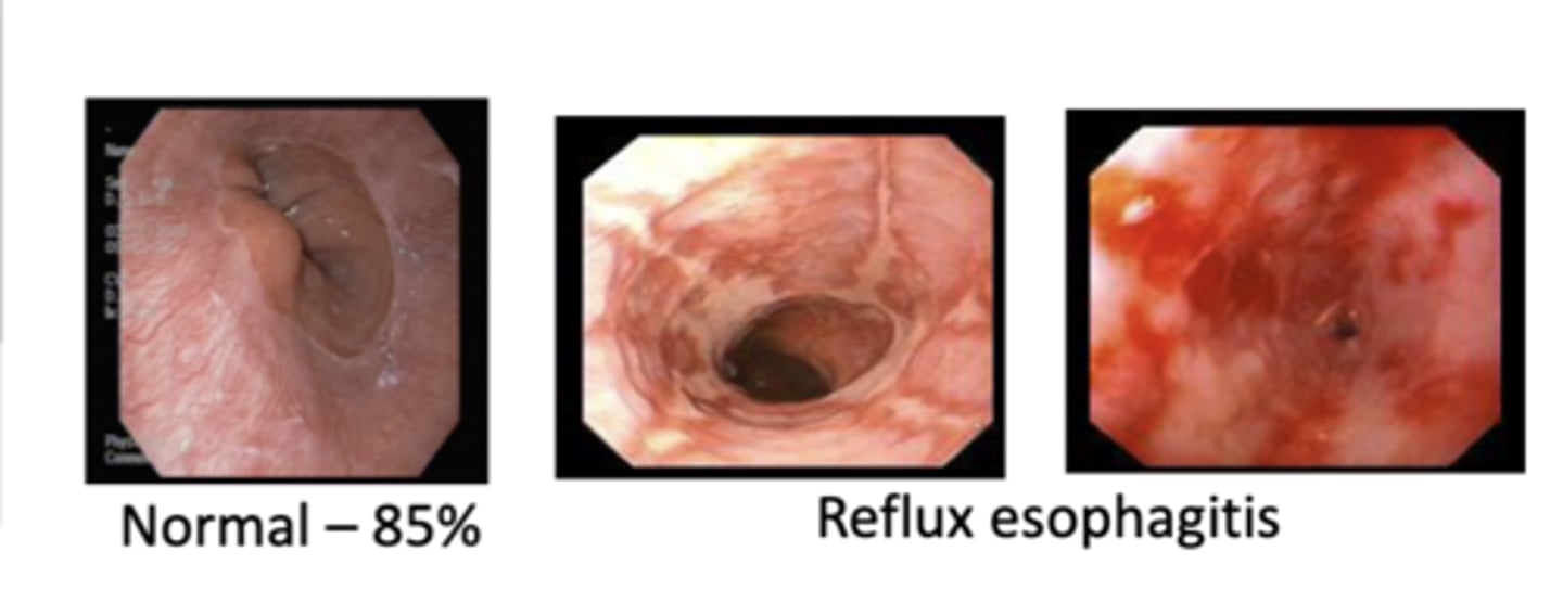 <p>reflux severe enough to cause symptoms and/or tissue injury ==&gt; causes reflux esophagitis</p>