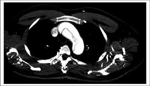 <p><strong>Aortic Aneurysm Dissection Diagnosis</strong></p><p>-Elevated lab values = _-____ ( &lt; ___ is unlikely to be a dissection), cardiac enzymes, ___, and lactate</p><p>-CXR = widened _________, ± ____-sided pleural effusion, or completely normal </p><p>-EKG = usually _______, helps you rule out MI</p><p>-CT __________ is the test of choice to rule out dissection, MI, and PE</p>