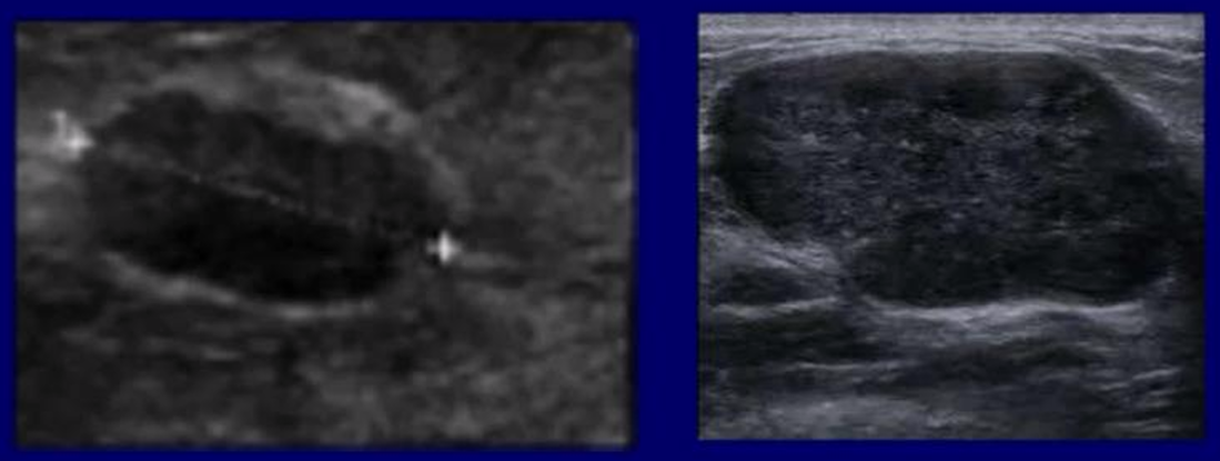 <ul><li><p>probably benign, 6-month follow up with continued periodic surveillance</p></li><li><p>image: fibroadenoma</p></li></ul><p></p>