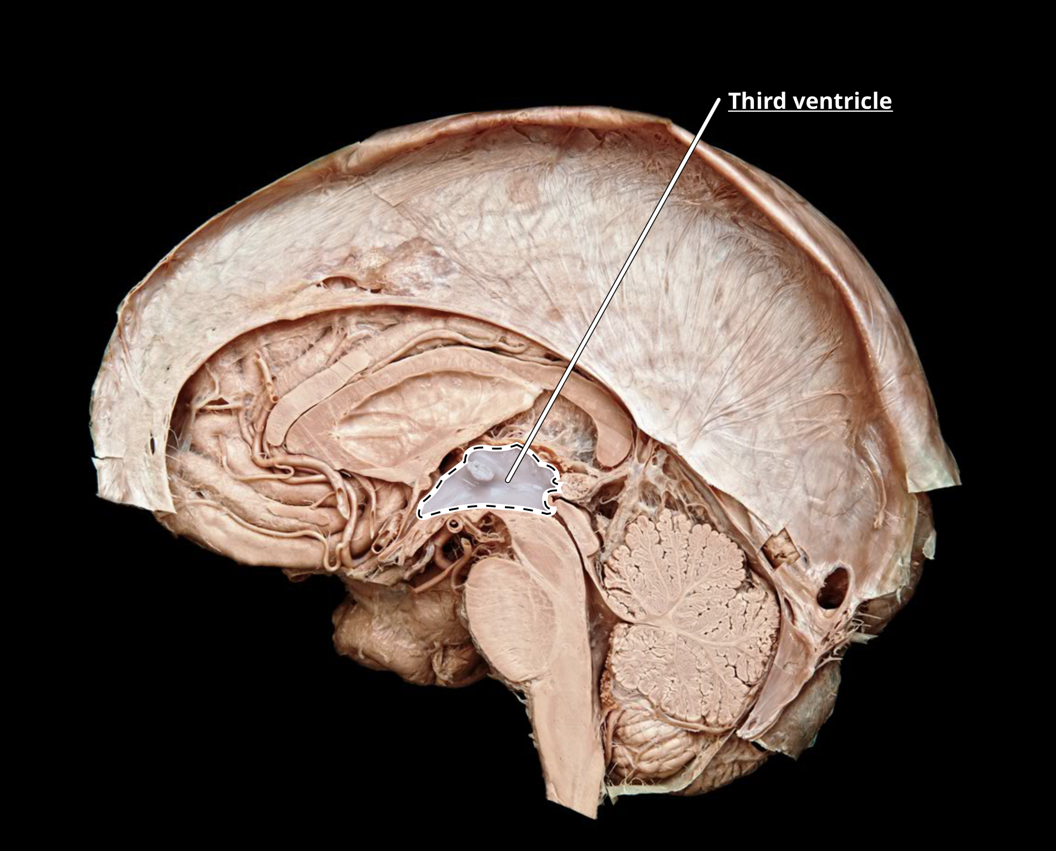 <p>third ventricle</p>