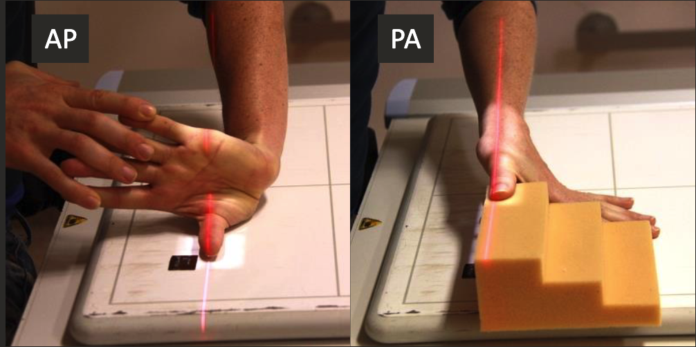 <ul><li><p>Thumb aligned parallel to IR edge.</p></li><li><p>Hand perpendicular to IR, thumb relaxed and parallel to IR.</p></li><li><p>CR perpendicular to IR, collimate to thumb including skin edge and carpometacarpal joint.</p></li></ul><p></p>