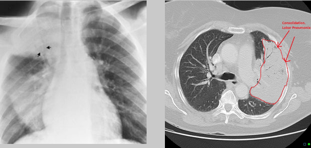 <p><strong>homogenous consolidation</strong> in segments or the entire lung — <strong>air bronchograms</strong> are present (when an entire lobe fills with fluid but has not collapsed)</p>