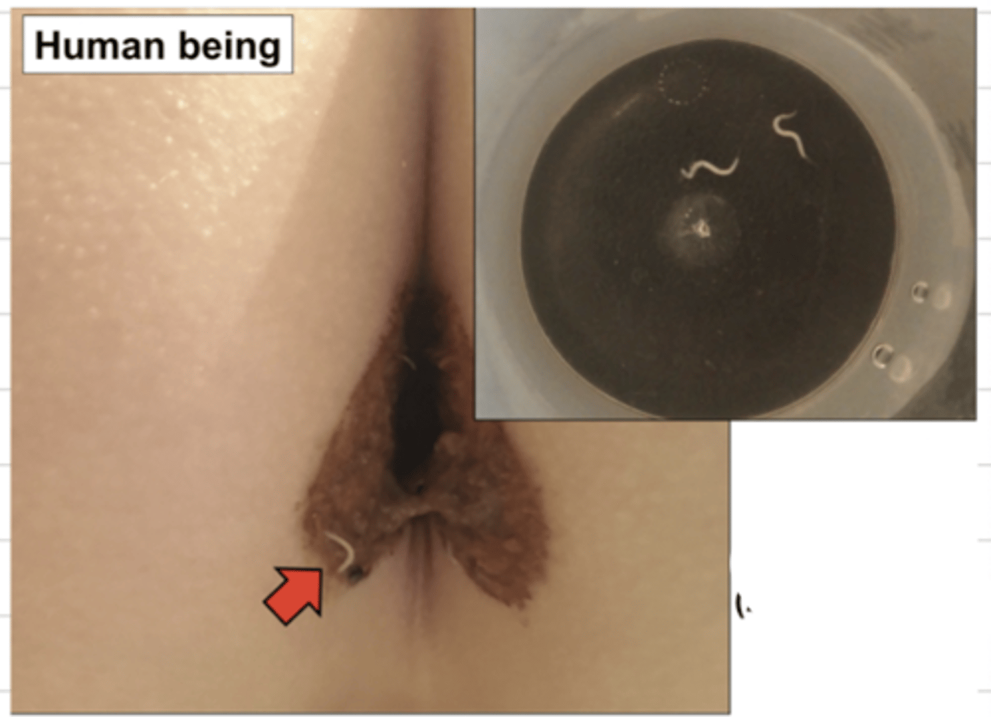 <p>what parasite is this human infected with? what is the name of the disease?</p>