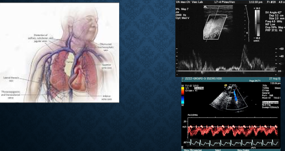 <p>collection of clinical signs resulting from partial/complete obstruction of blood flow through SVC </p><ul><li><p>obstruction most commonly from thrombus formation or tumor infiltration </p></li></ul><p></p>