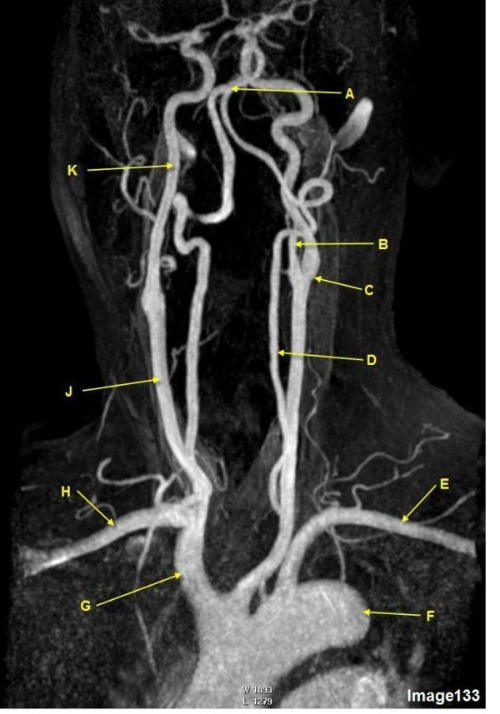 <p>Letter C in Image 133 is pointing to:</p><p>A. Middle cerebral artery</p><p>B. Common carotid bifurcation</p><p>C. VertebroBasilar junction</p><p>D. Internal carotid artery</p><p>E. External carotid artery</p><p>F. Abdominal aorta</p>