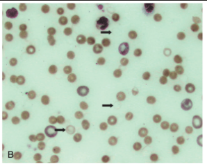 <ul><li><p><span>Numerous Heinz bodies can disrupt the membrane sufficiently to result in ghost cells - empty red blood cells with just a membrane and Heinz body remaining</span></p><ul><li><p><span>Associated with oxidation-induced intravascular hemolysis</span></p></li></ul></li></ul><p></p>