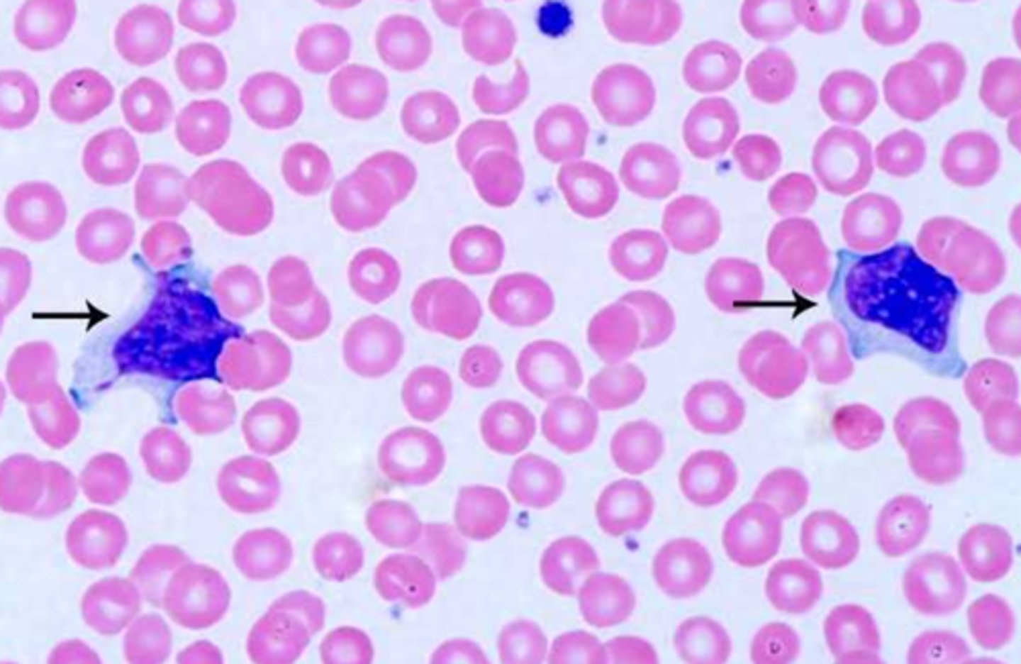 <p>leukocytosis, lymphocytosis, elevated CRV (c reactive protein)<br>- heterophiles antibodies and blasts present <br>- reactive lymphocytes and increased liver enzymes</p>