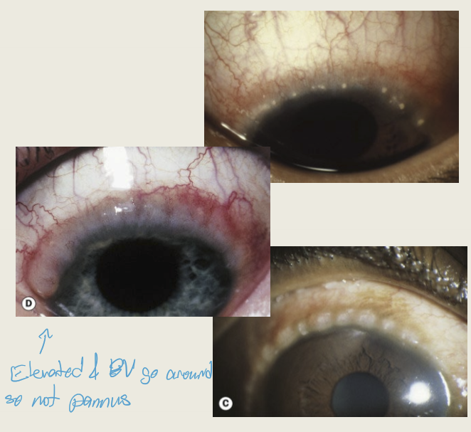 <ul><li><p>Limbal papillae: gelatinous appearing papillae at the limubs&nbsp;</p></li><li><p>Horner-Trantas dots: focal white dots at the limbus. Dots are made up of degenerated epithelial cells and eosinophils&nbsp;</p></li></ul><p></p>